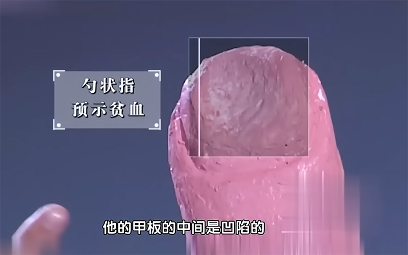 勺狀形指甲.jpg